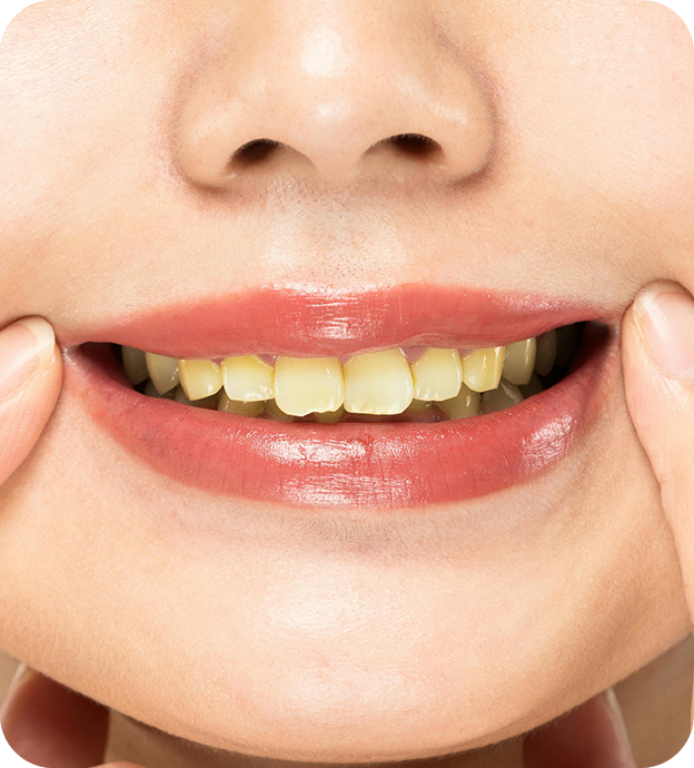 yellow teeth